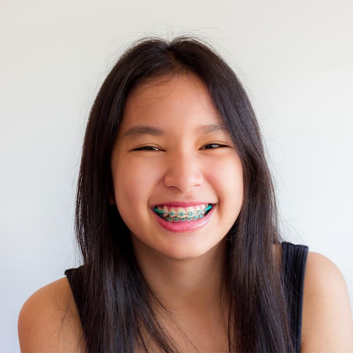Braces Orthodontic Treatment